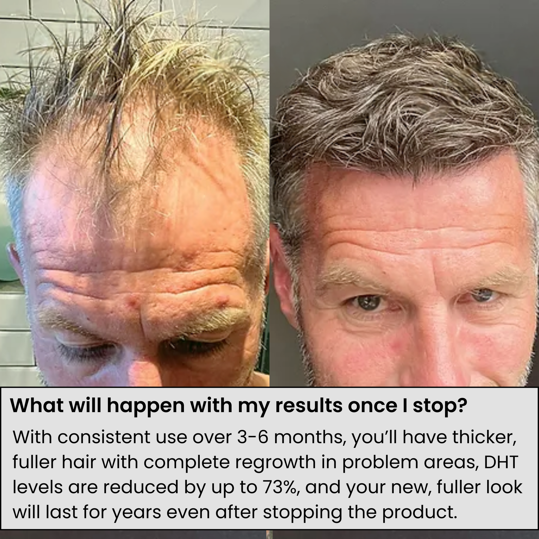 Magnuminfuse™ Hair Regrowth System